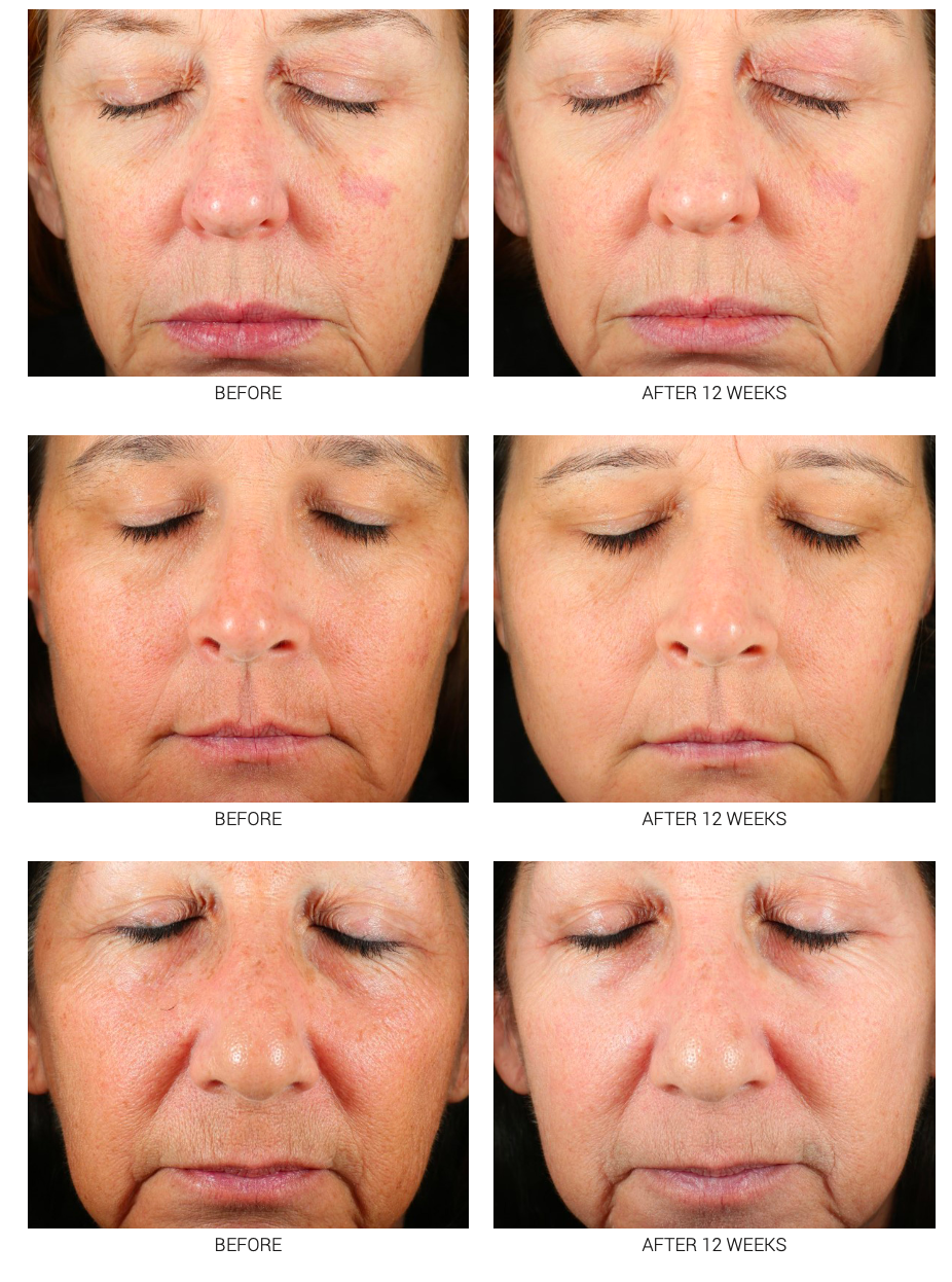 Accelerated Aesthetics — Medical-Grade Retinoid Serum 2.5% & 5%