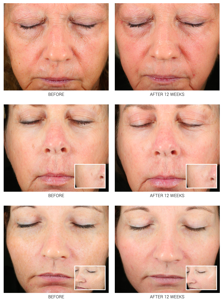 Accelerated Aesthetics — Medical-Grade Retinoid Serum 2.5% & 5%
